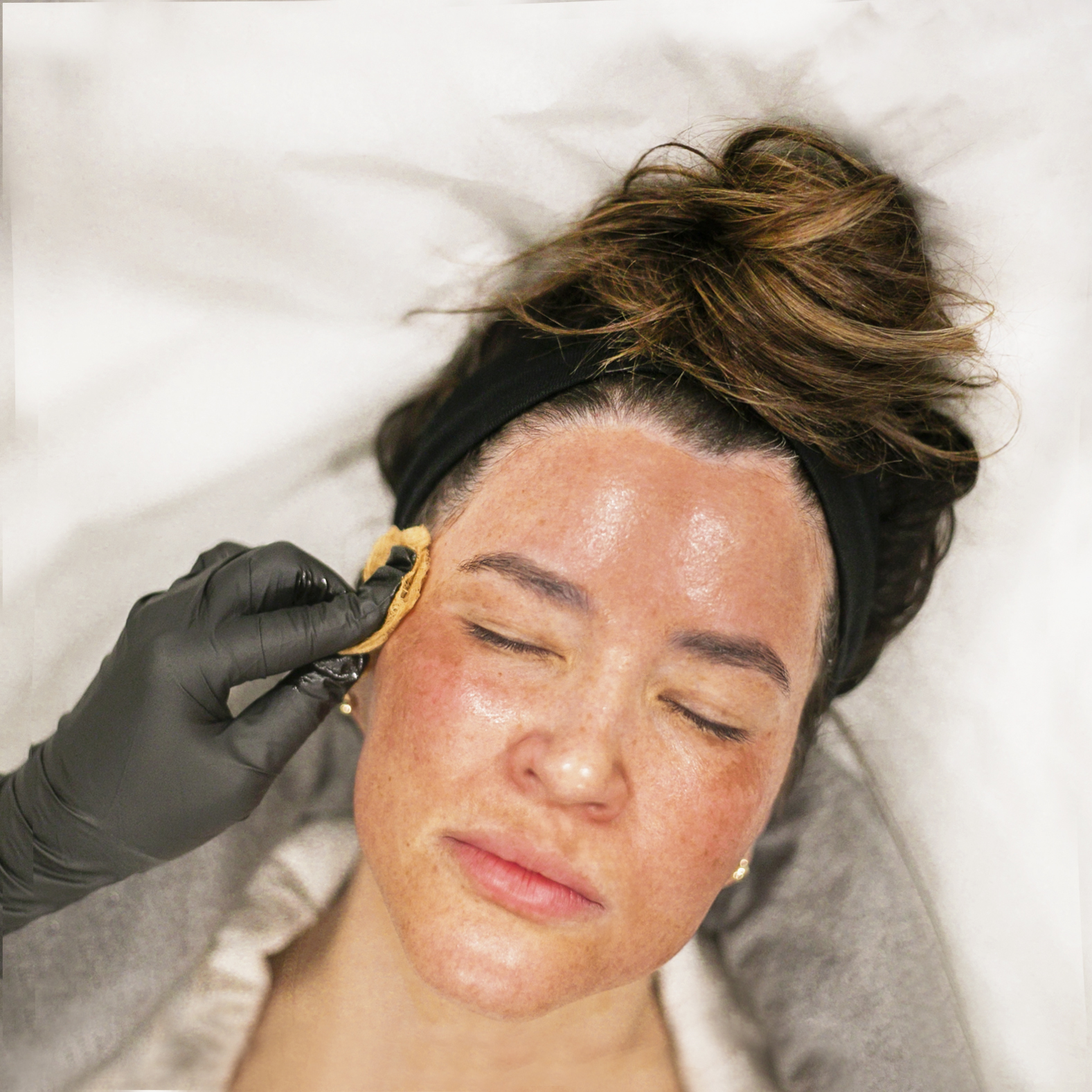 microneedling in knoxville tn